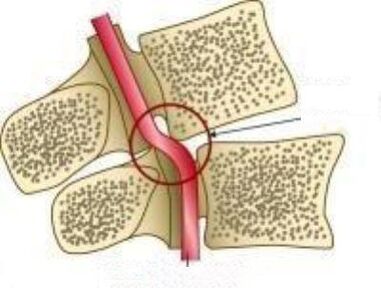 Ваил артериясының ваил синдромы