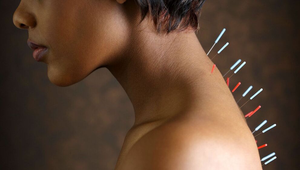 Жатыр мойны остеохондрозымен акупунктура