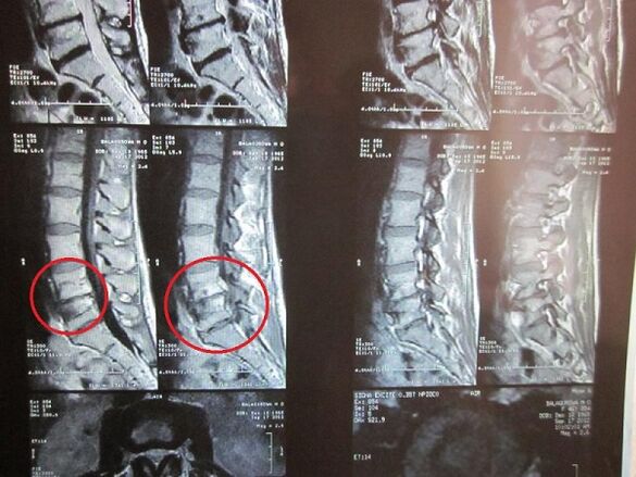 Жатыр мойны остеохондрозының диагностикасы