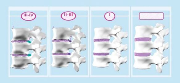 Жатыр мойны остеохондрозының кезеңдері