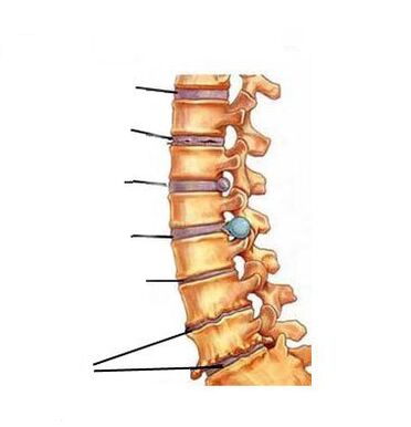Остеохондроз қалай дамиды