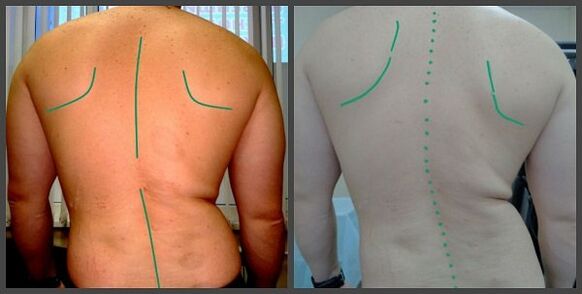 Остеохондрозымен омыртқаның қисықтығы