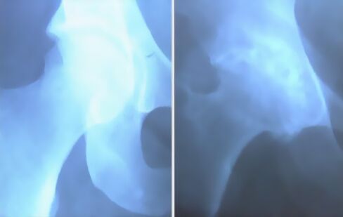 Тізе буынының артрозы