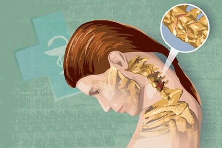 Остеохондроздың рефлексі белгілері